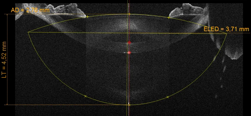 OCT-biometer