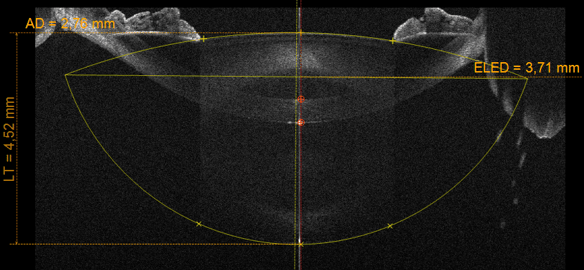 OCT-biometer