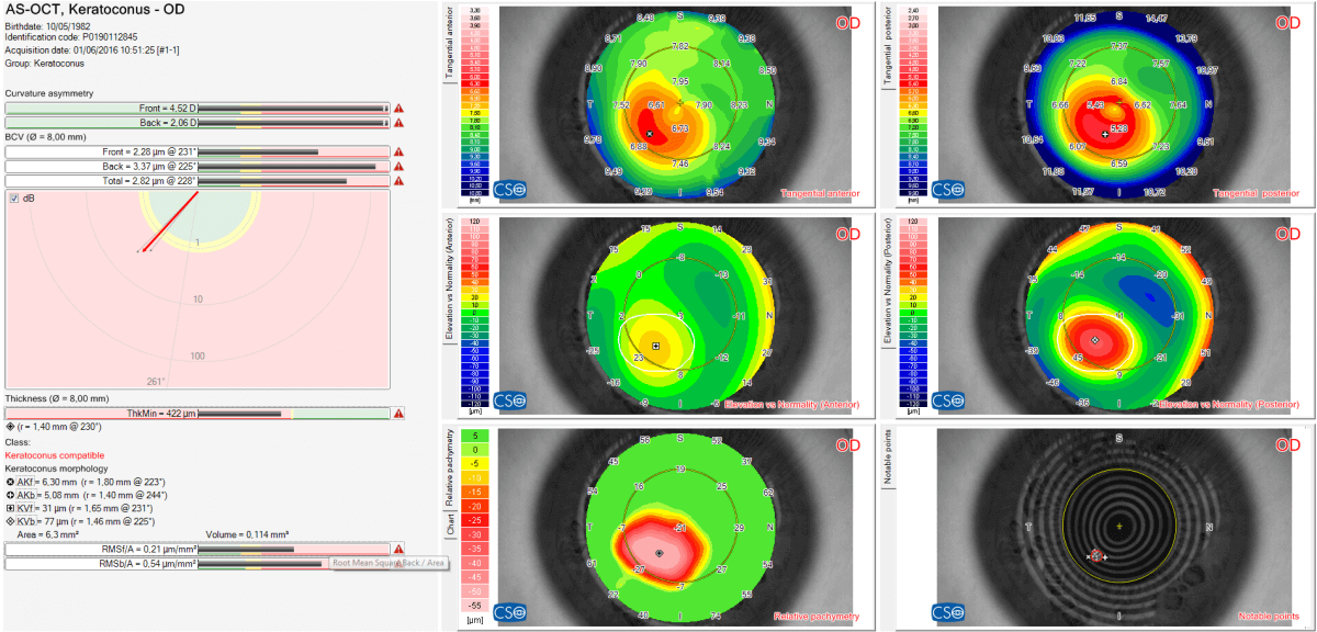 OCT-keratoconus-summary