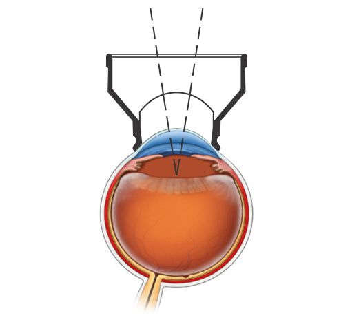 YAG-Capsulotomy