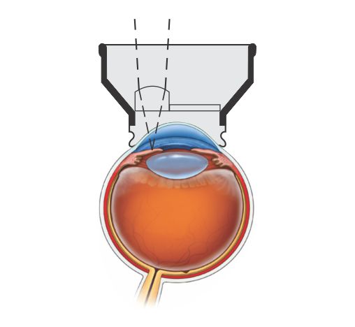 YAG-Iridectomy